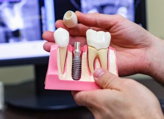 Что представляет собой имплантация зубов?