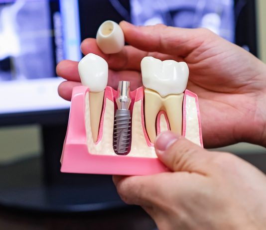 Что представляет собой имплантация зубов?