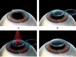 Этапы лазерной коррекции зрения
