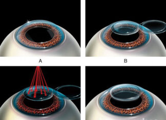 Этапы лазерной коррекции зрения