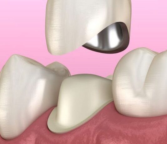 Когда необходимо устанавливать металлокерамические коронки