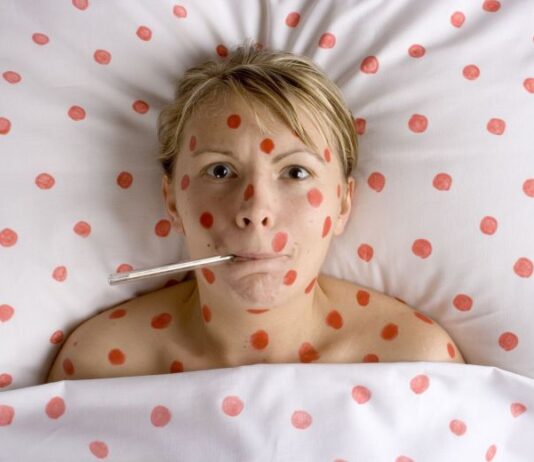 Первые симптомы кори и ее последствия для организма, с чем можно перепутать недуг